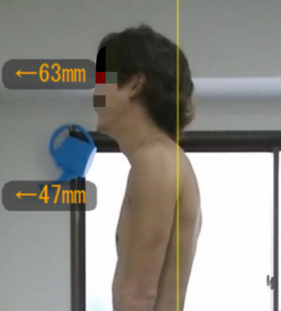 猫背タイプ④　首まっすぐ