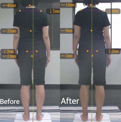 噛み癖を改善したら、身体の歪みも改善