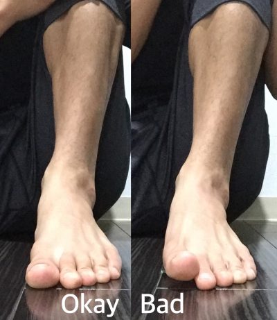美脚 浮き指の状態 前から