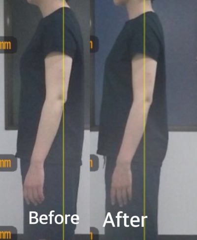 脇肉痩せ 事例1