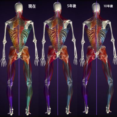 がに股女子 5年後10年後の筋肉バランス 後
