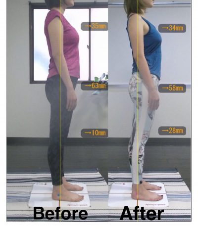 【5ヶ月】Before＆After 右