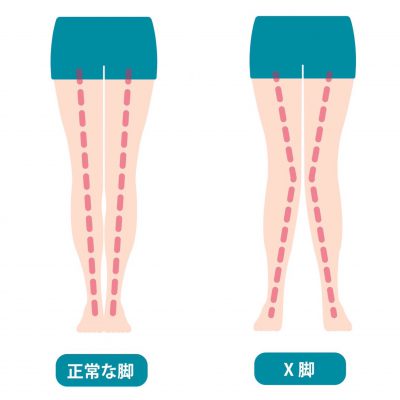 足の歪み 3タイプ x脚