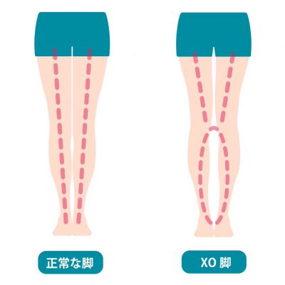 足の歪み 3タイプ xo脚