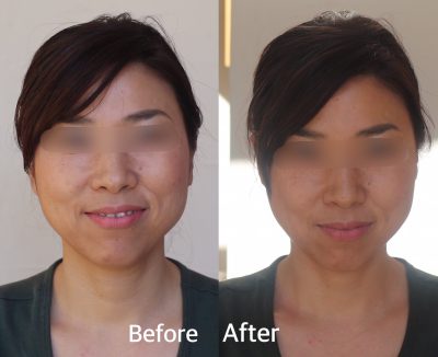小顔トレーニング before&after