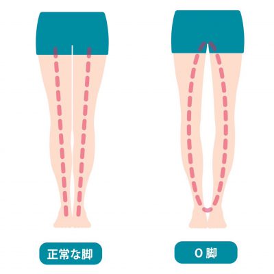 足の歪み 3タイプ o脚